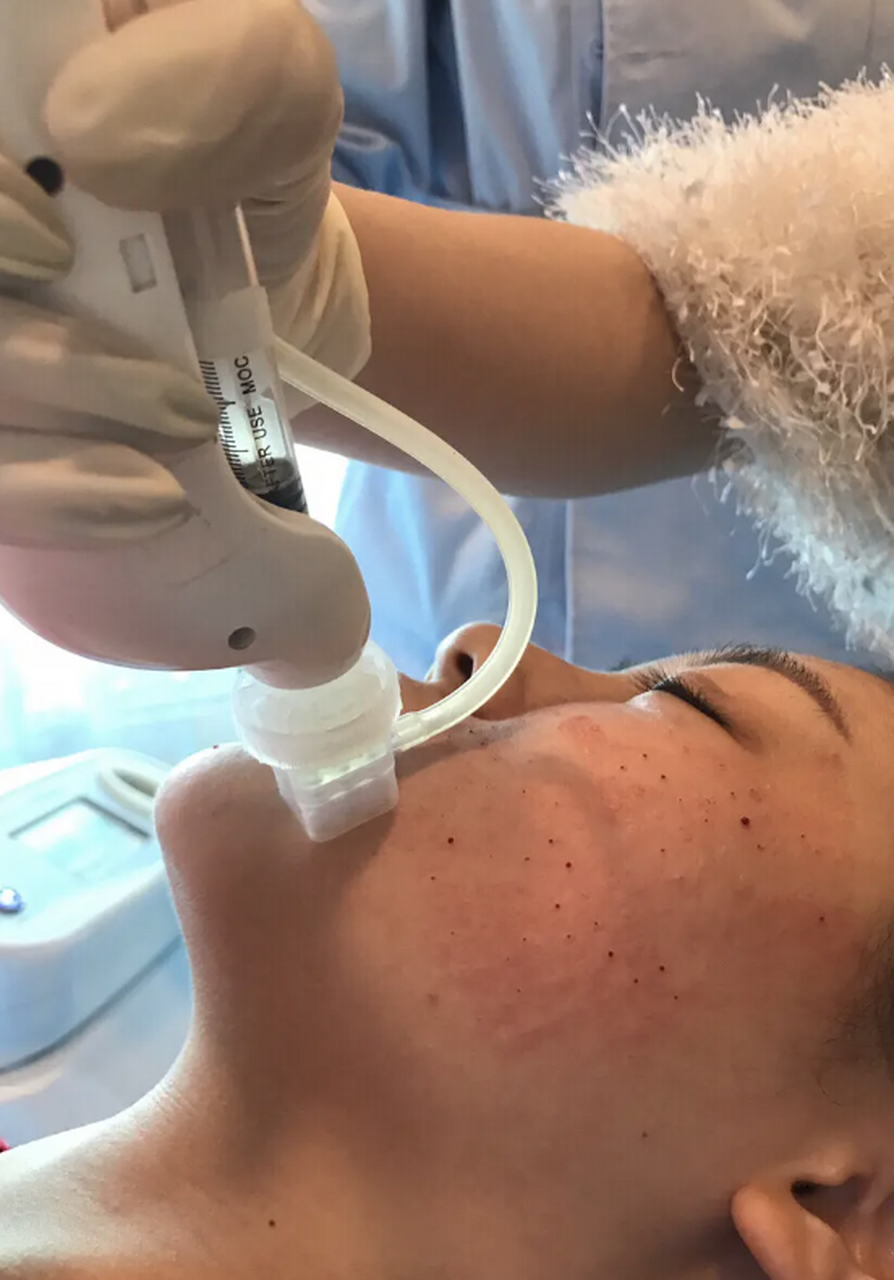 水光针# 水光针多久打一次比较好 水光针是一种修复肌肤,补充水返的