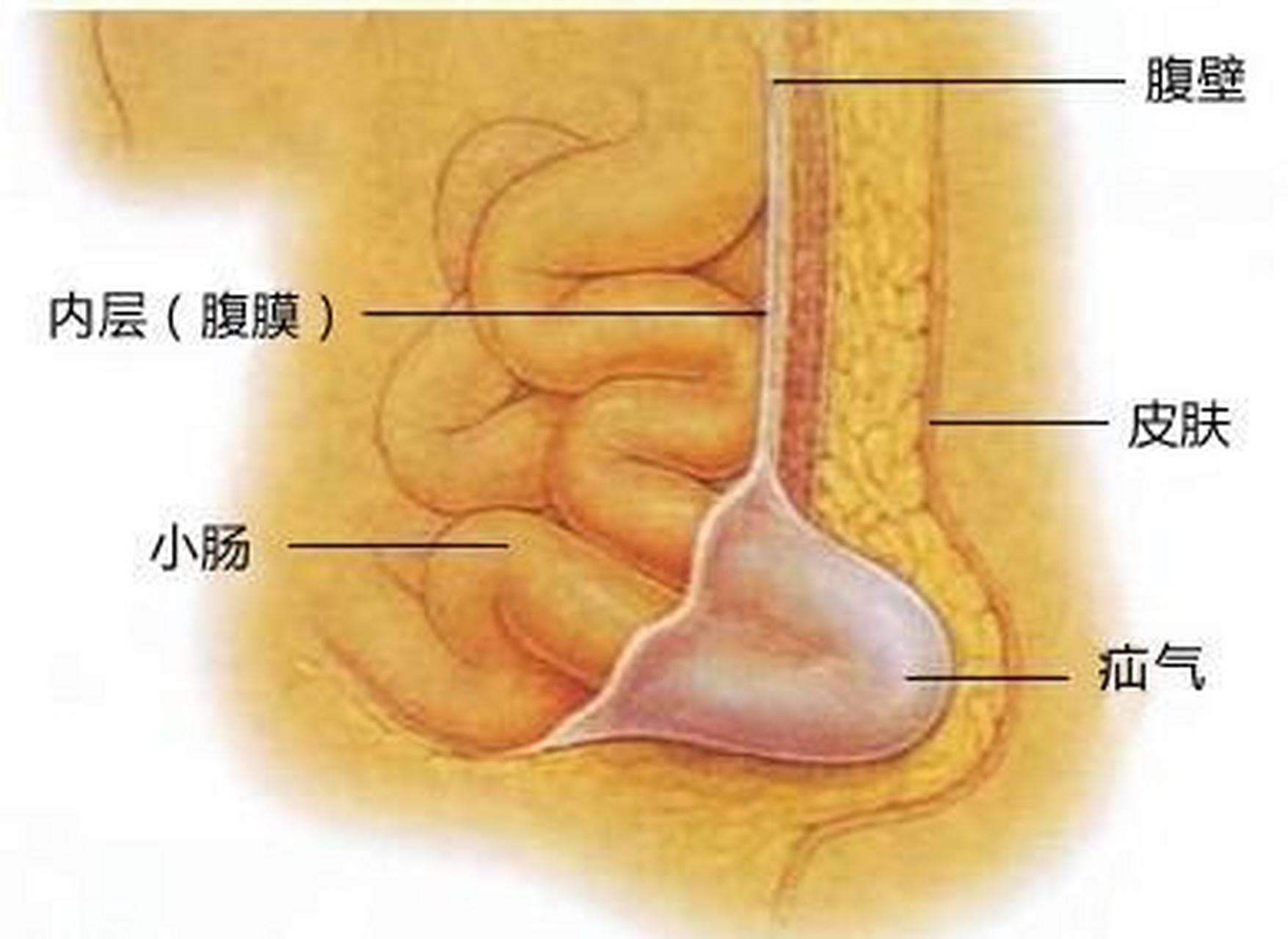 小肠气是什么病图片