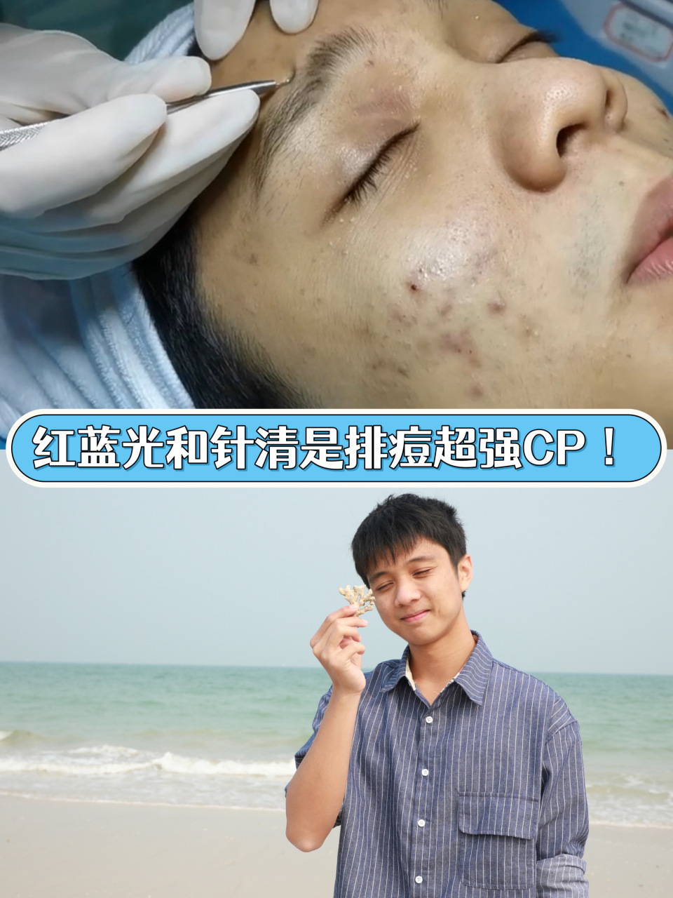 其实有一组祛痘cp,平价有效,它们就是红蓝光和针清!