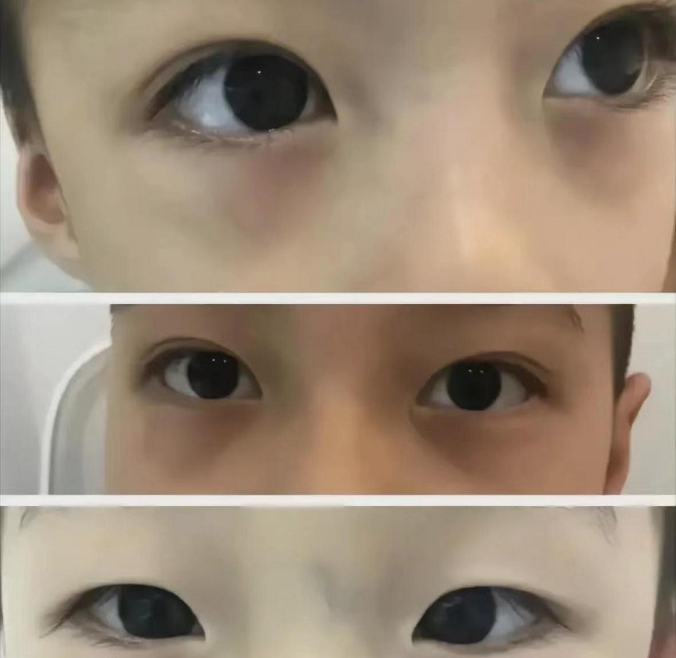 孩子下眼脸发青发暗,有的发红,这种情况,眼袋叫做气池.