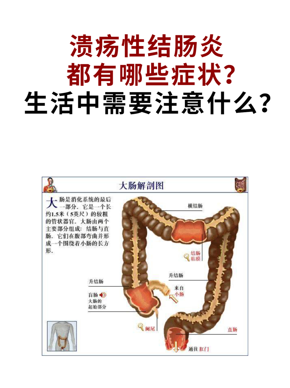 腹瀉伴粘液膿血便 腹瀉且伴有粘液膿血便是潰瘍性結腸炎的典型症狀,其