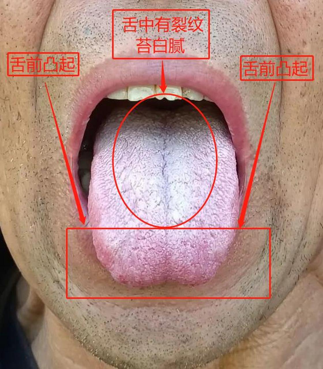 目前最难受的就是恶心,头晕,头蒙,我们一起来看舌象 标记1:舌前有凸起