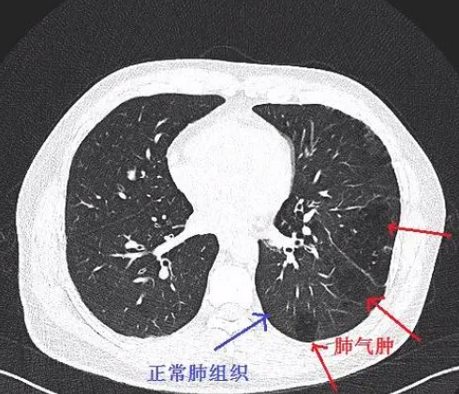 轻度肺气肿图片