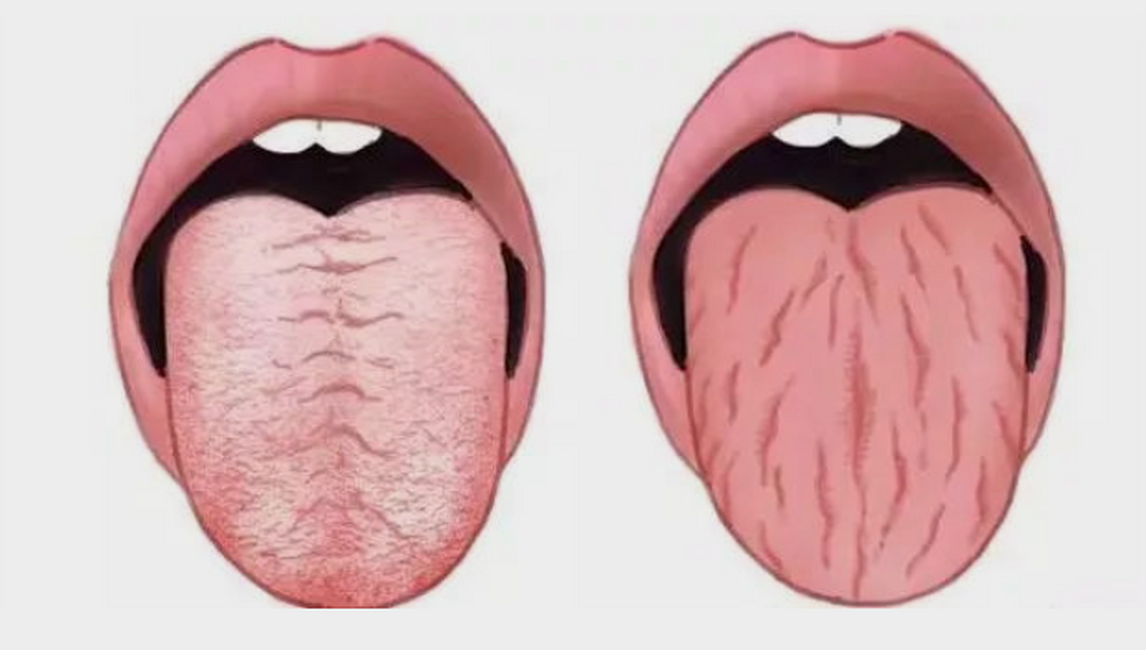 有的人舌头两边有一圈牙齿印,而且舌质淡苔白,舌体胖大,这都是脾胃