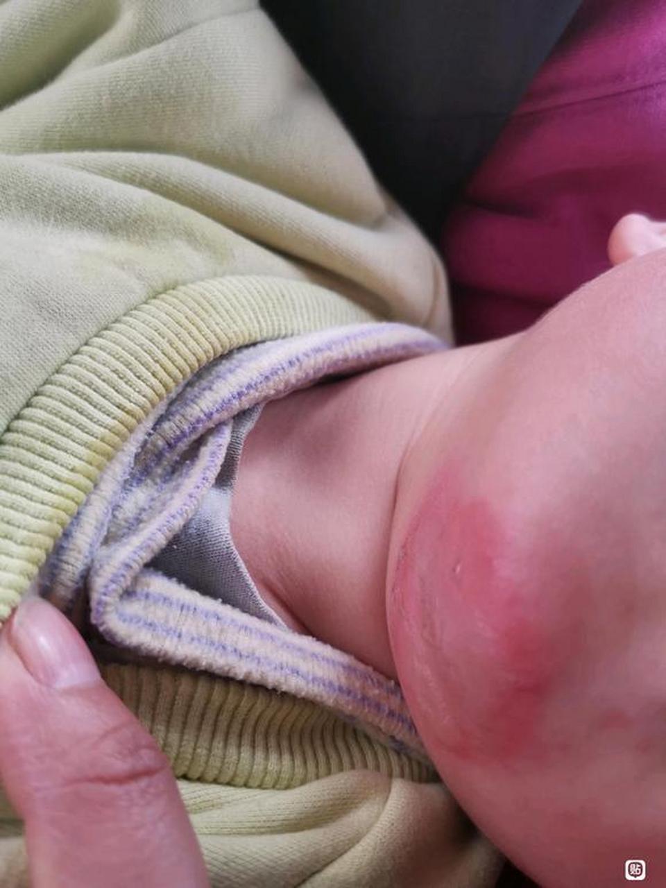 宝宝深二度烫伤的治疗1  1月7日 不愿意想起的日子[叹气] 由于看护不