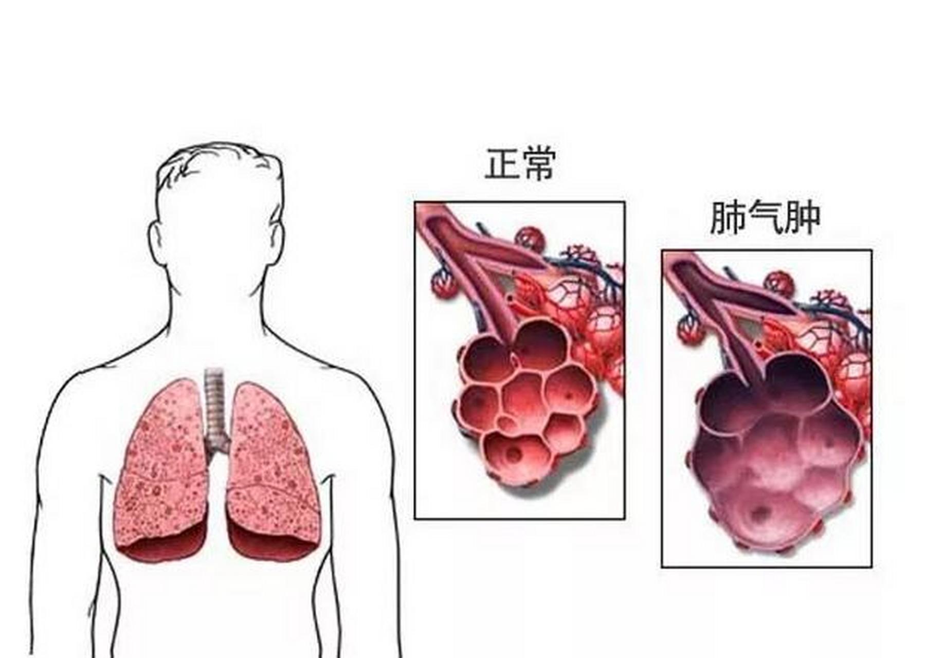 肺气肿患者,这个方子存好了,我只发一次 大家好,我是唐仕欢医生,今天