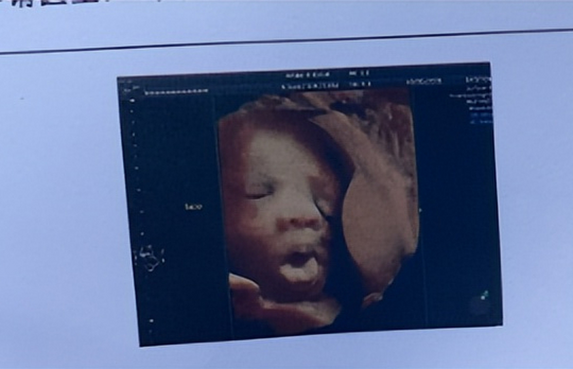 夏女士37岁第二胎孕26周,做四维彩超时,发现宝宝在调皮地吐舌头,夏