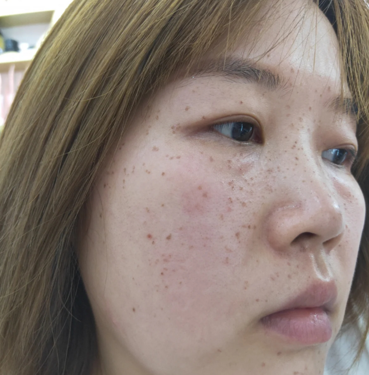 因为干燥的皮肤容易出现色素沉积,导致斑点的形成.