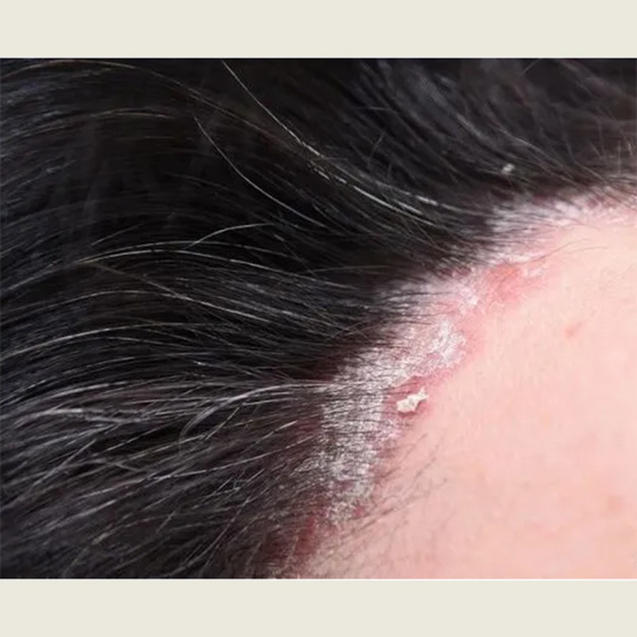 大块儿头屑和脂溢性皮炎曾给我的生活带来巨大烦恼.