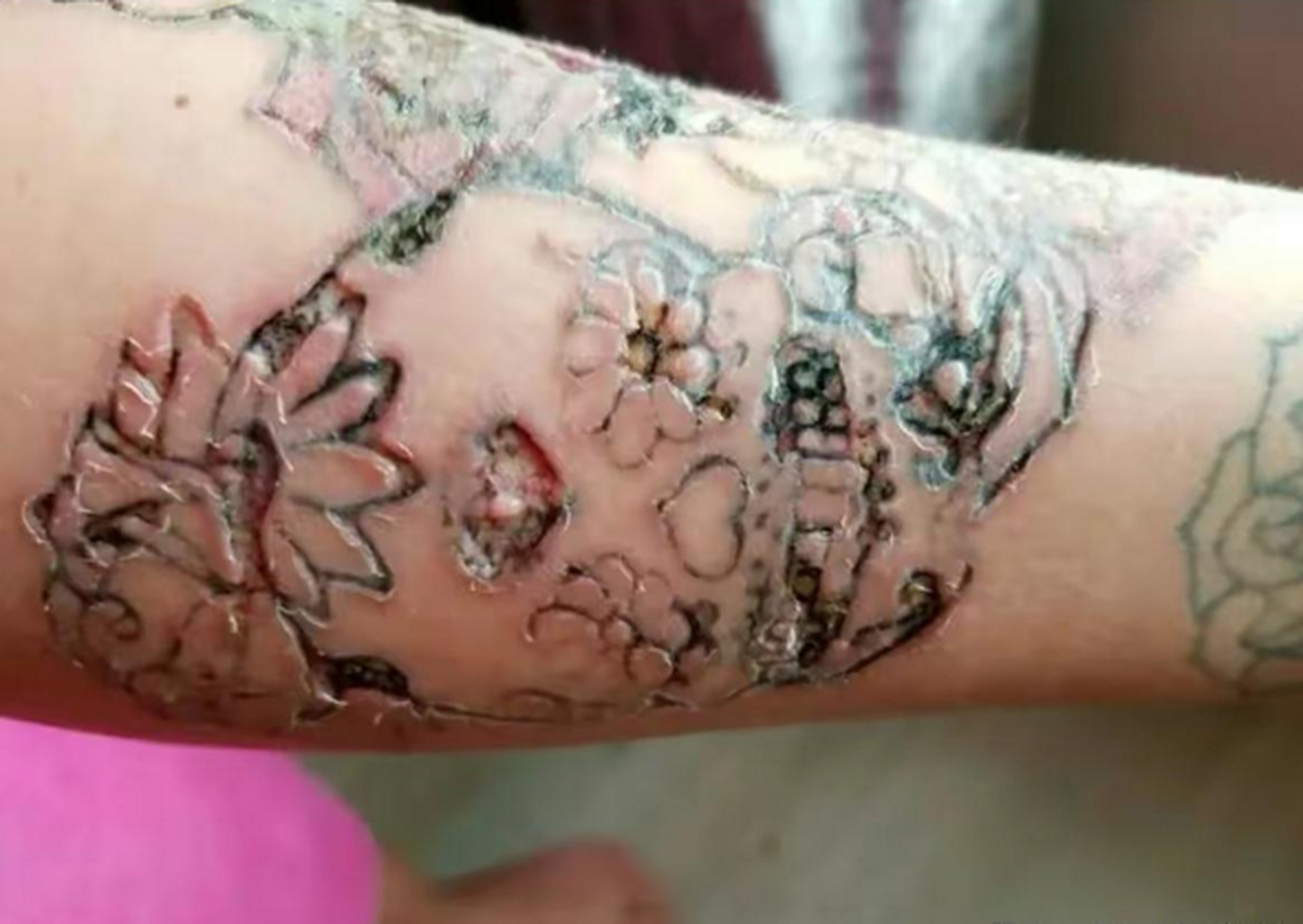 纹身感染后的样子!好恐怖!好好的身体干嘛要纹身呢!