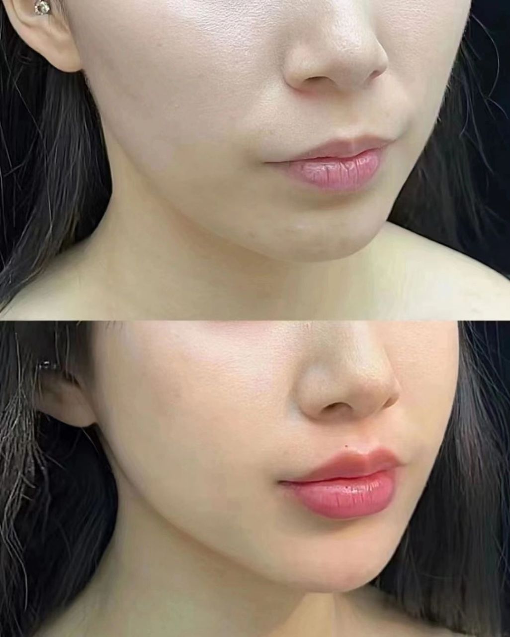 姑娘花了两万做的填充,完全解决了法令纹凹陷的问题,这看着不得年轻五