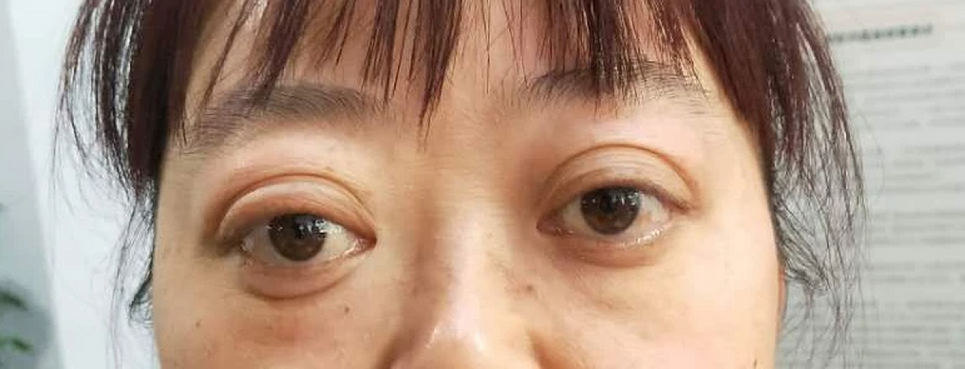 甲亢除了造成眼球突出变得难看,对眼睛的影响还有这6项!  1.