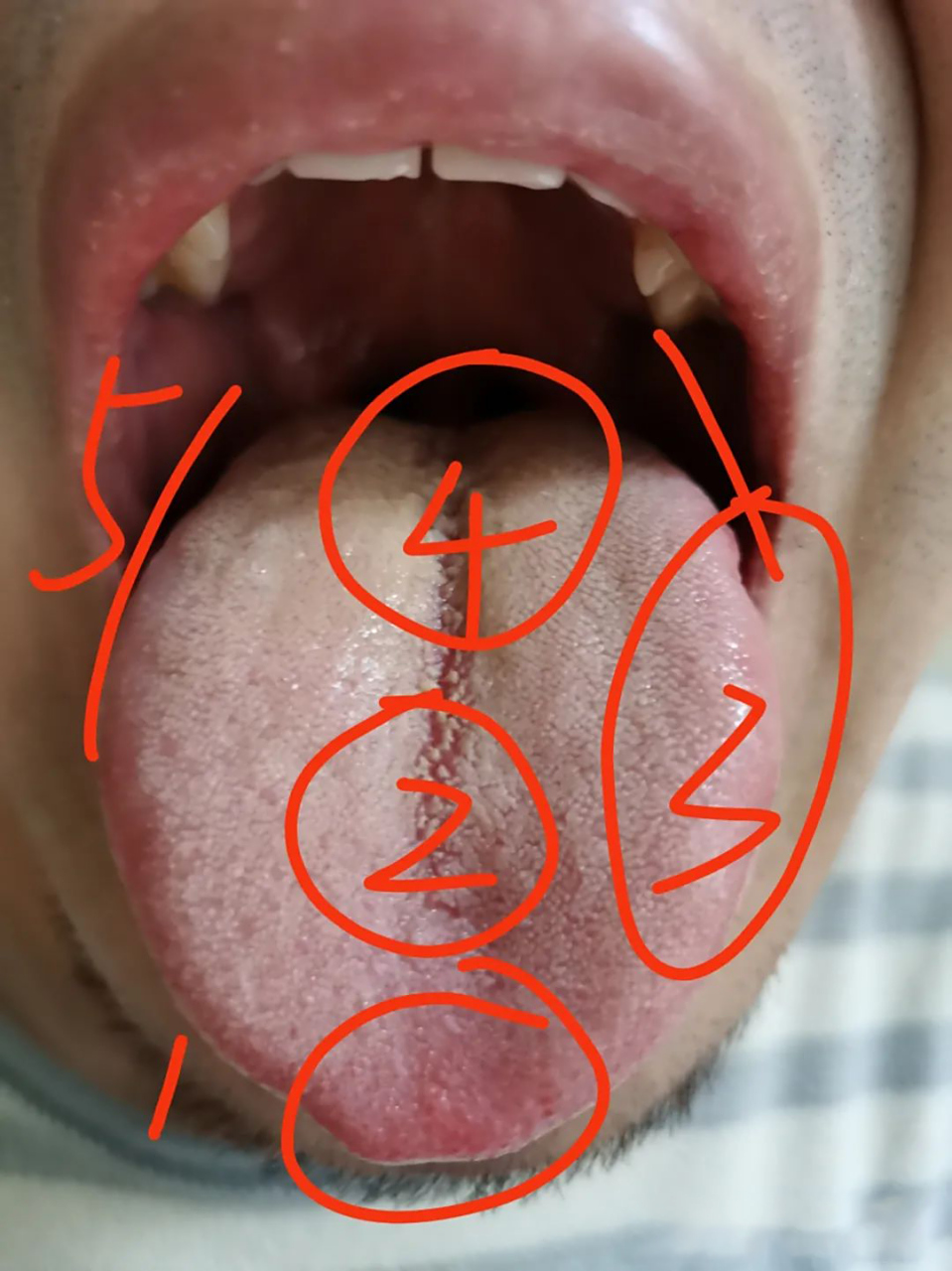 这是一个前列腺炎,睡眠多梦,失眠的舌象  :1:舌尖向外突出比较多,而且