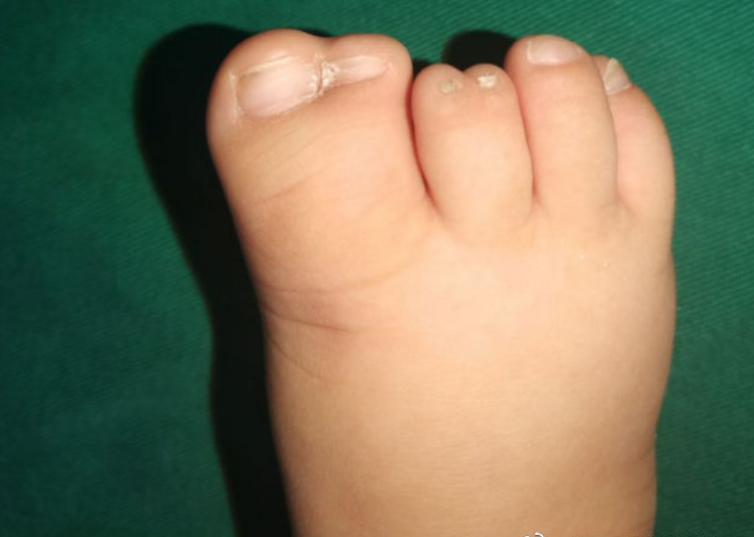 孩子脚趾并在一起,妈妈心疼孩子手术遭罪,认为手术有风险,孩子年龄小