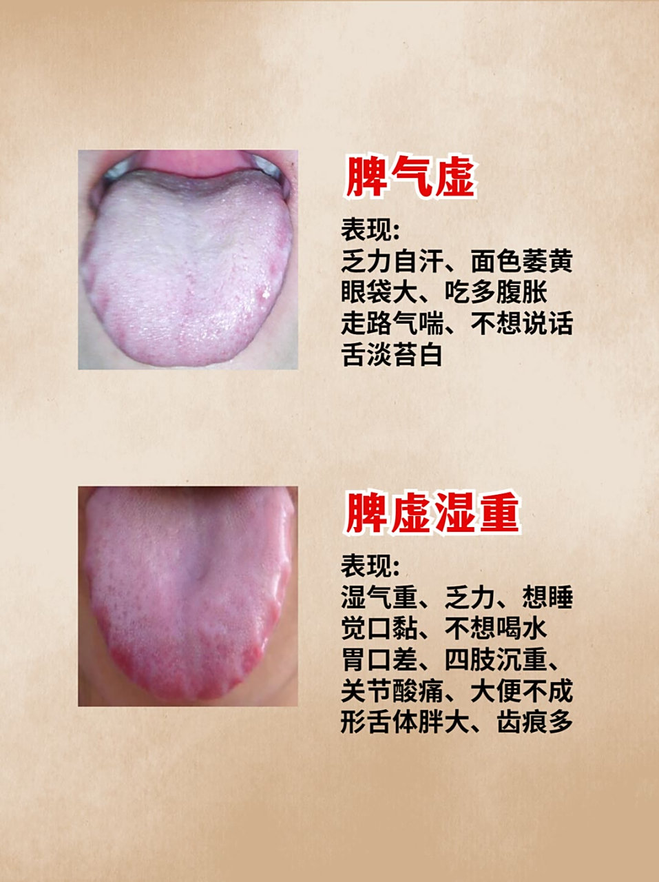 脾胃虚弱的6种证型,对照舌苔,看看你是哪一种?