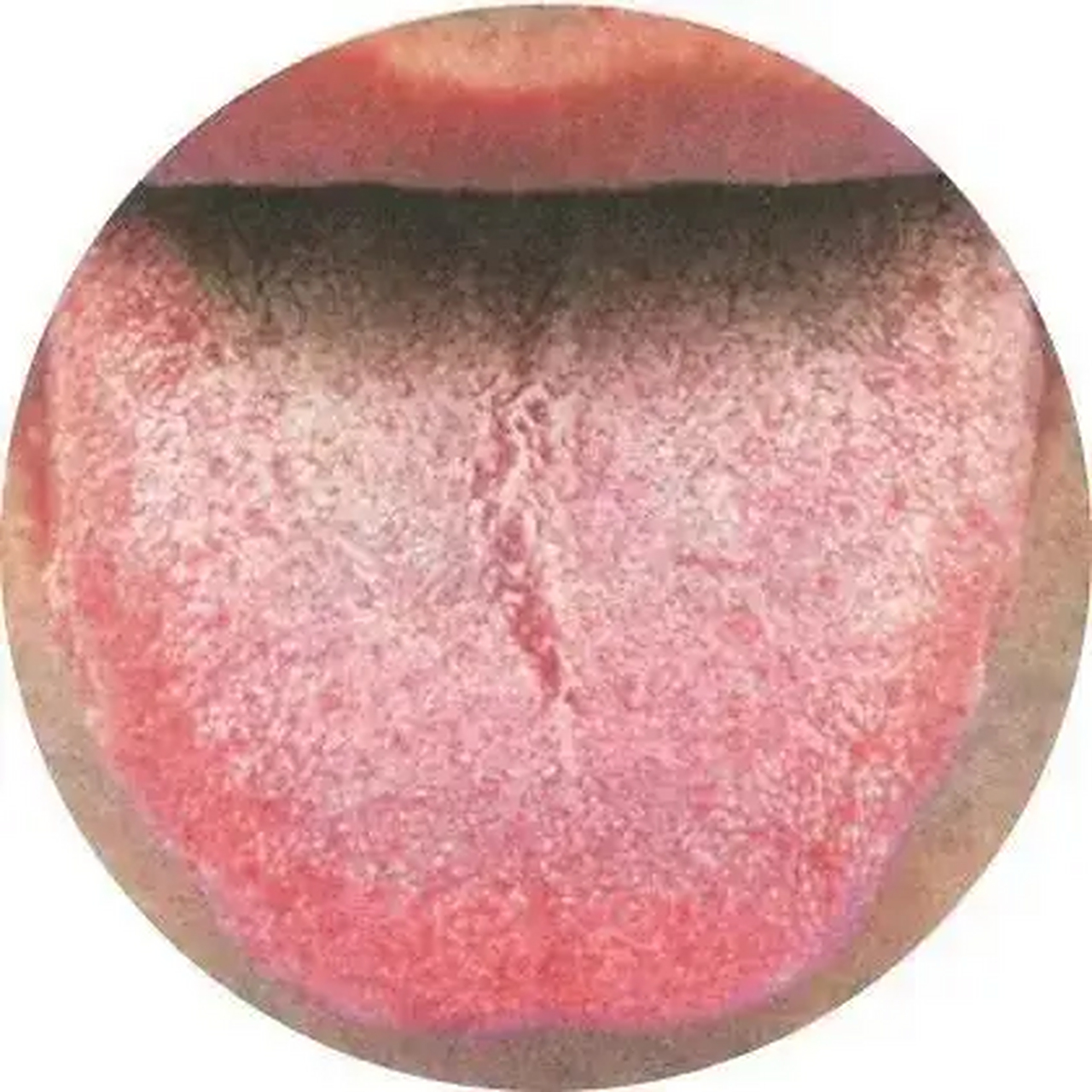 中医认为,出现红舌是因患者热盛致气血沸涌,舌体