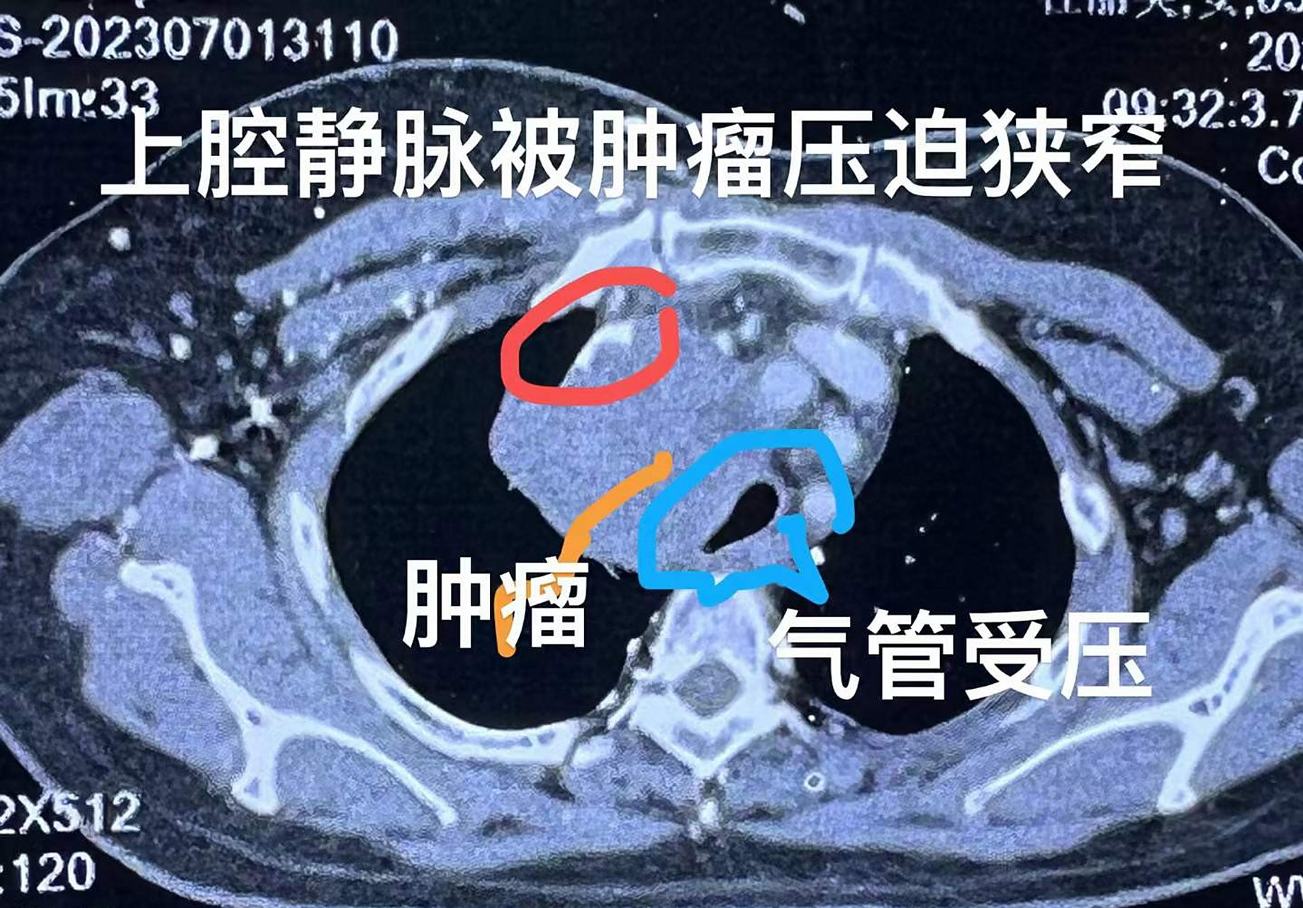 中央型肺肿瘤压迫上腔静脉引起血液回流障碍,表现为脖子颜面部肿胀伴