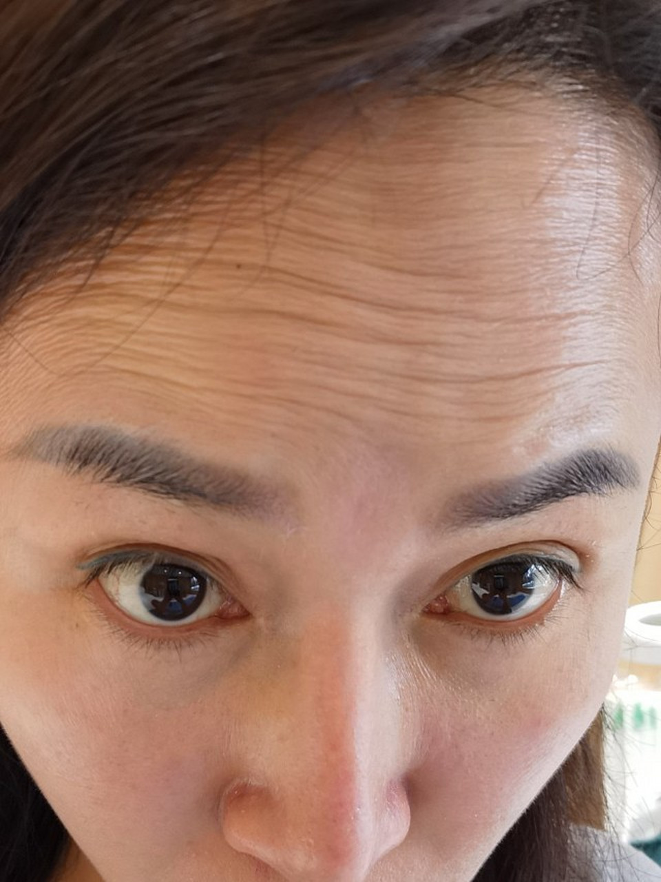 体验前变美诉求:抬头纹比较严重啦!