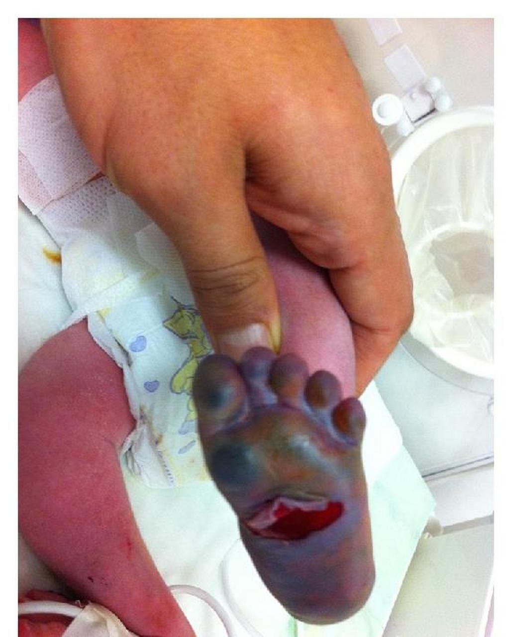一例新生儿足跟采血后足部皮肤缺血性坏死的病例  新生儿足跟采血很