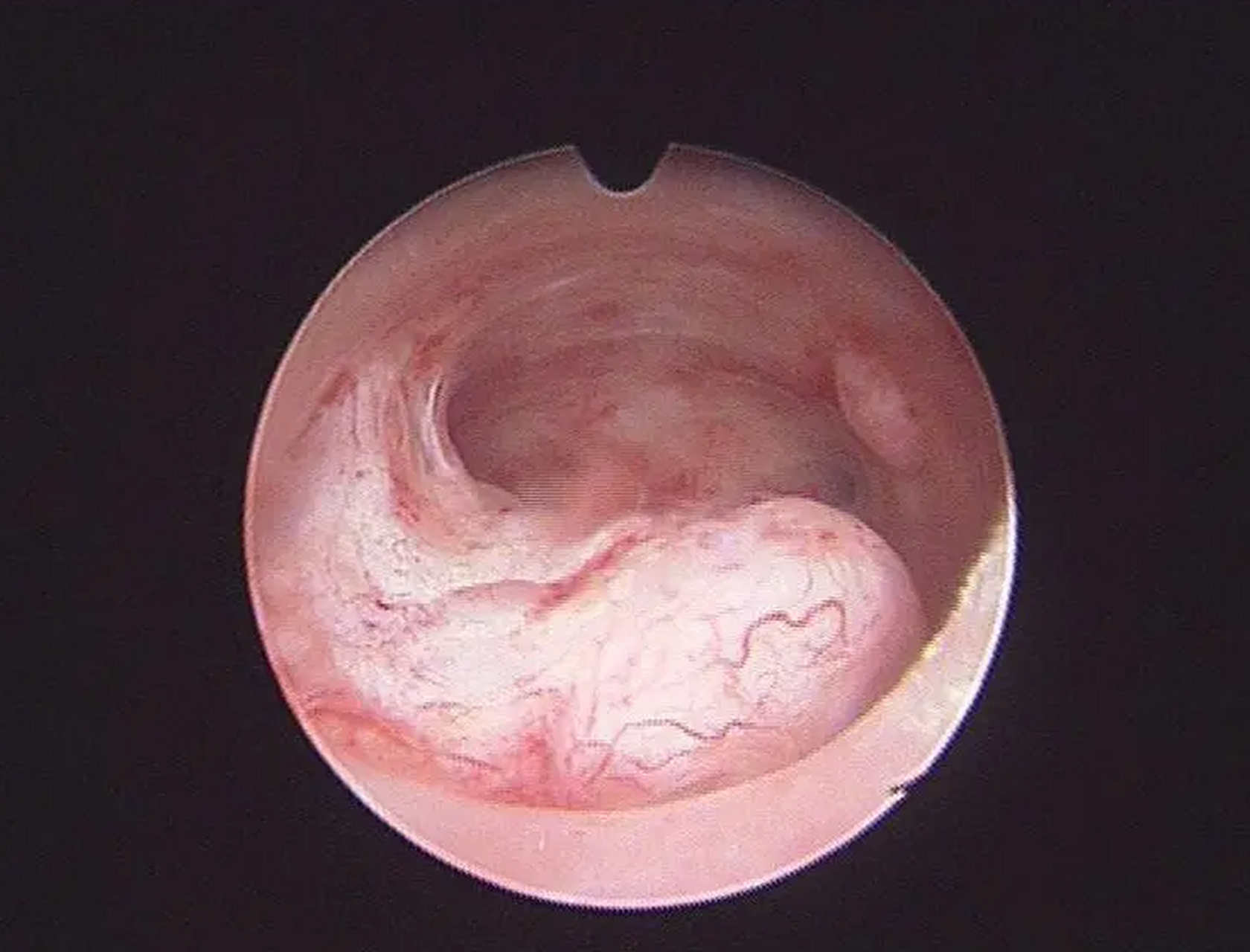 子宫内膜息肉是引起子宫异常出血的主要原因之一,也可导致不孕,痛经