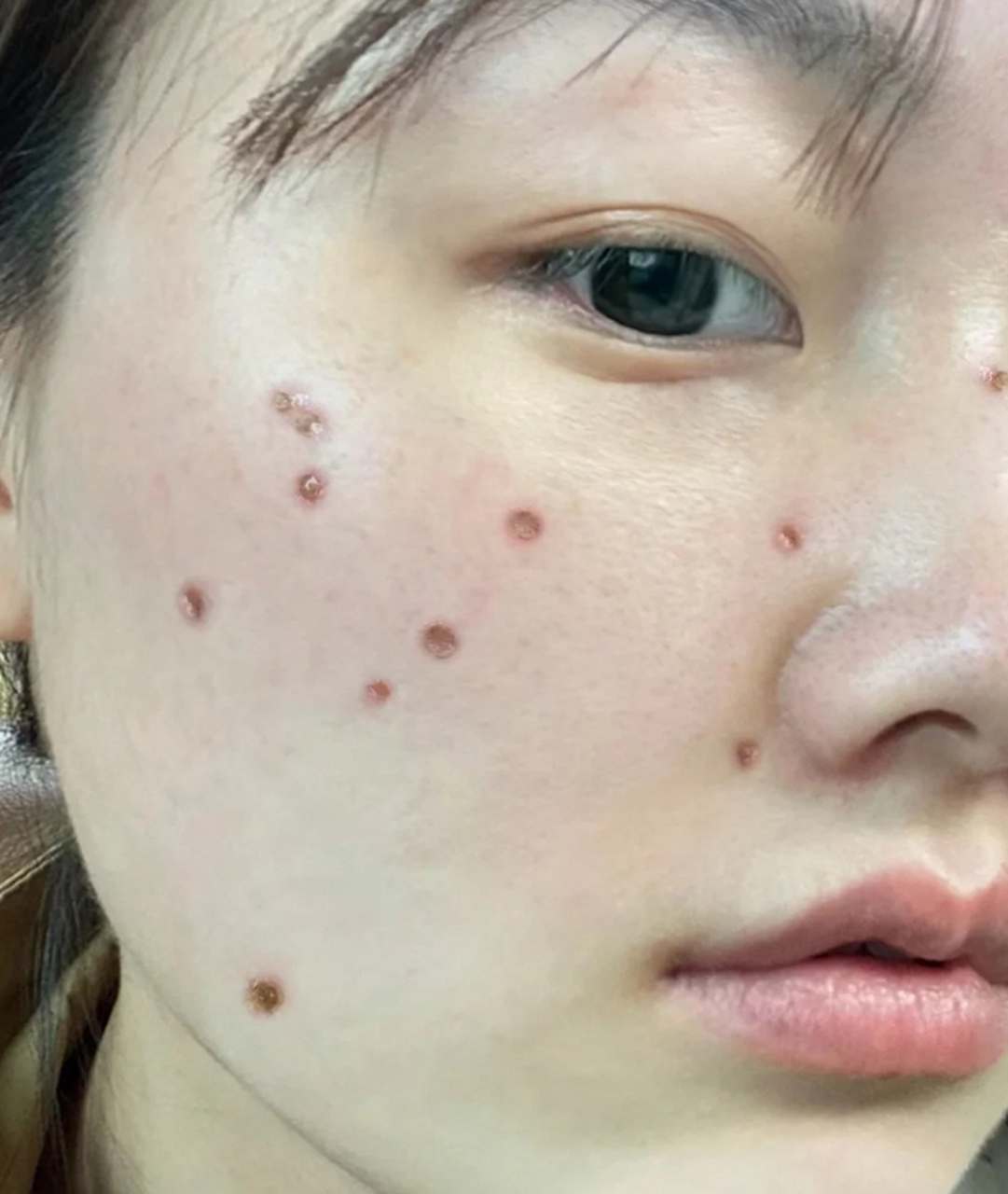 点痣留下的疤痕怎么去除 #医美科普挑战赛#  点痣是一种常见的美容