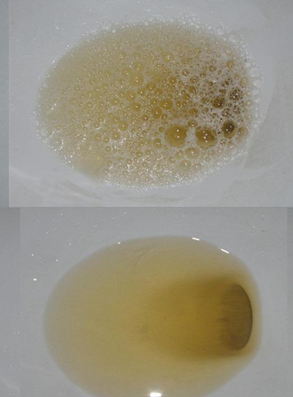 肾病综合症是以大量蛋白尿,低蛋白血症,水肿,高血脂症等为共同特盏哪