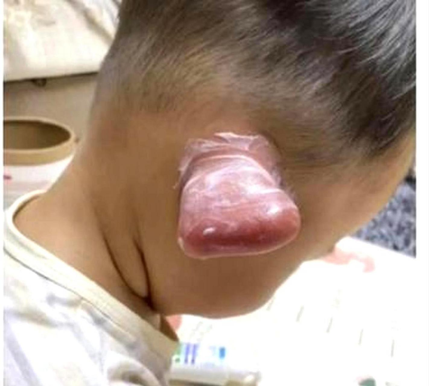 小侄子的耳朵被蚊子咬了,变成了顺风耳,看起来非常可爱.