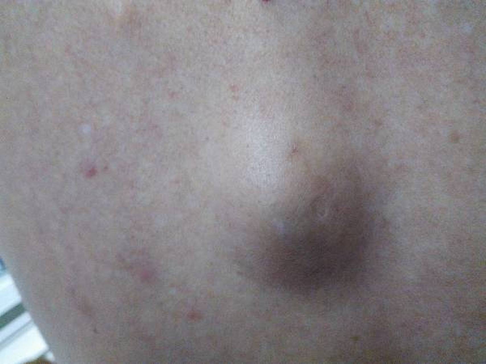 我今年40岁,洗澡的时候发现后背有一个肿块,不疼也不痒,没有在意.