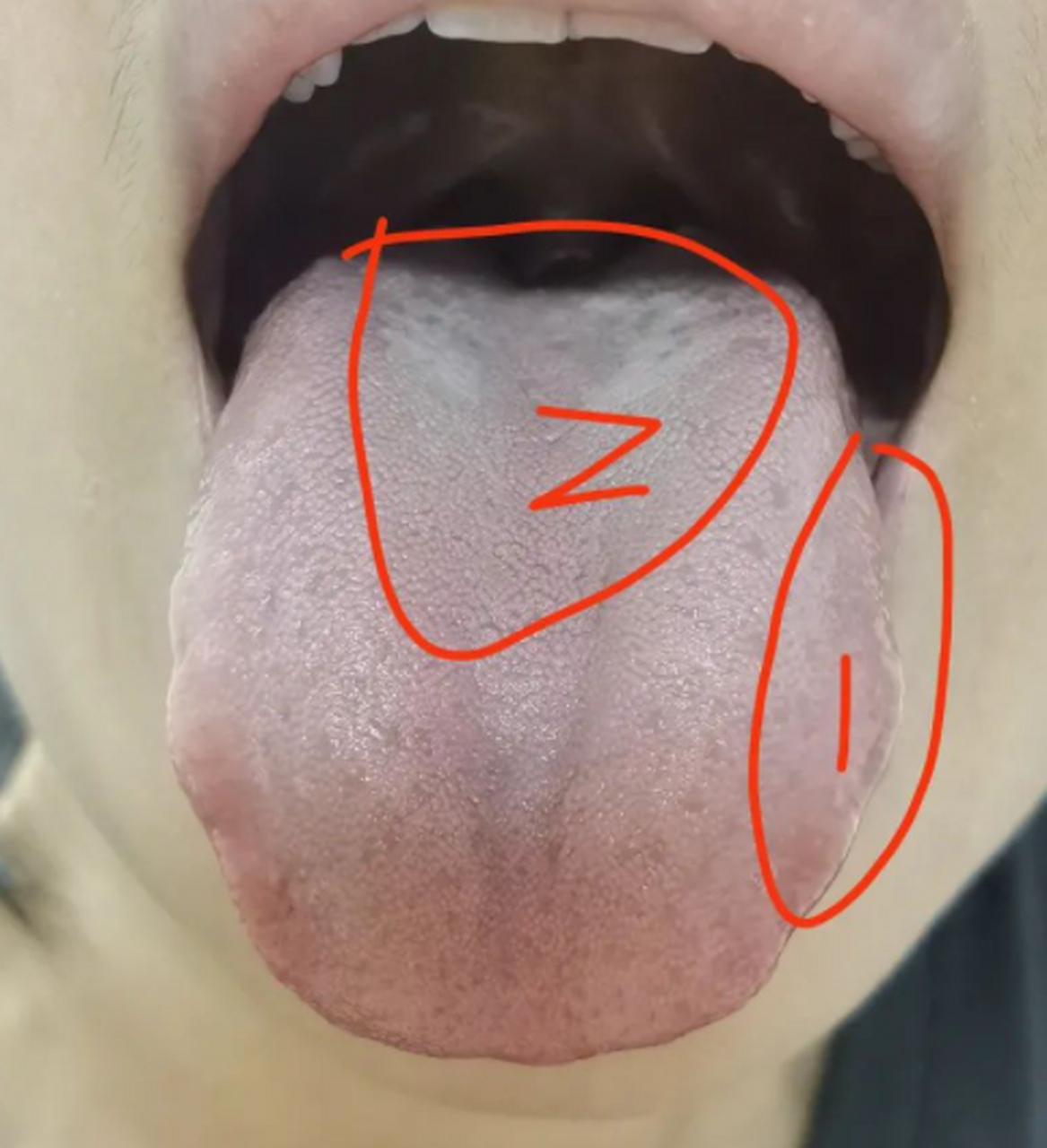 这个舌象舌苔铺满舌体胖大,舌质淡白,半透明感  舌苔铺满舌体胖大,舌