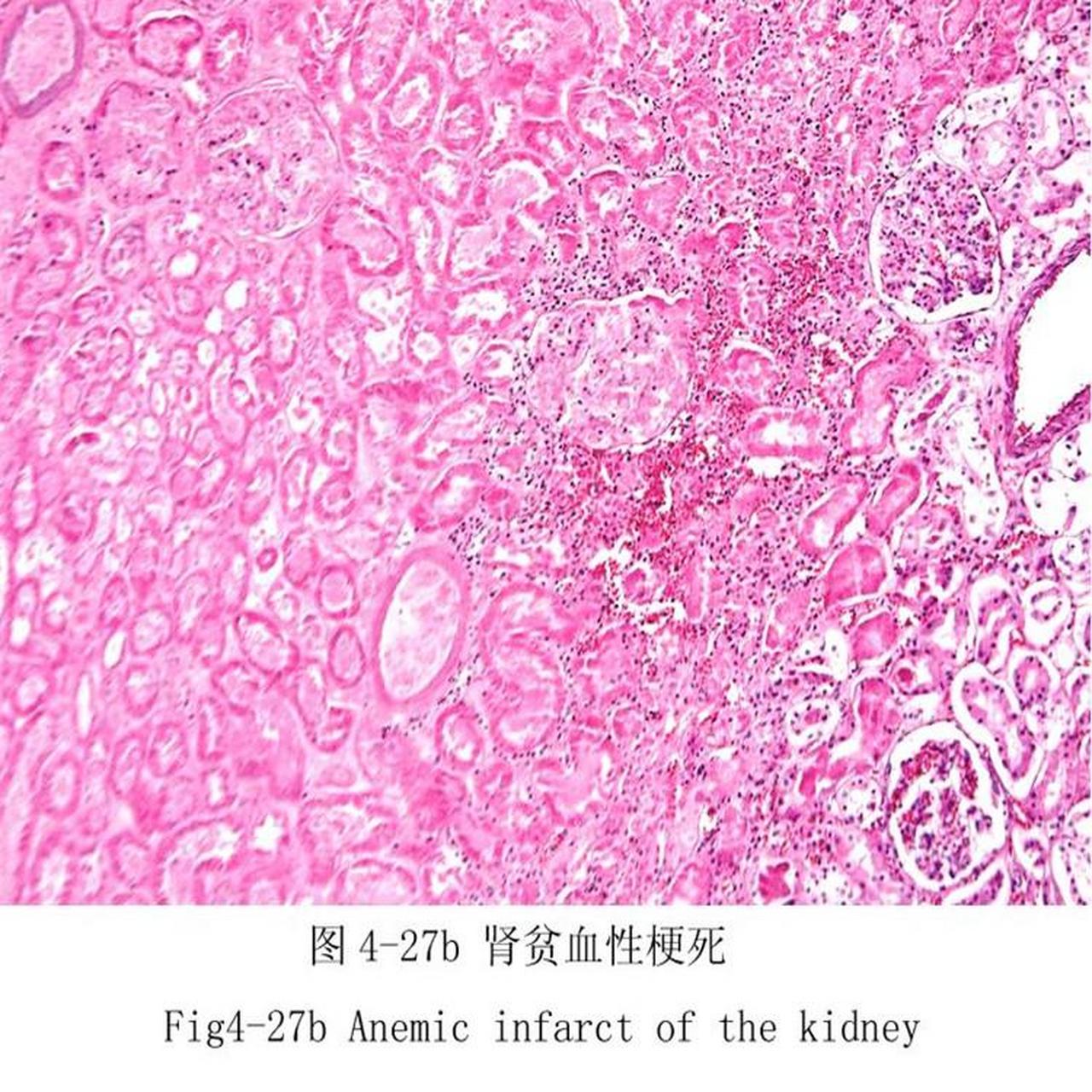 肾贫血性梗死图片图片