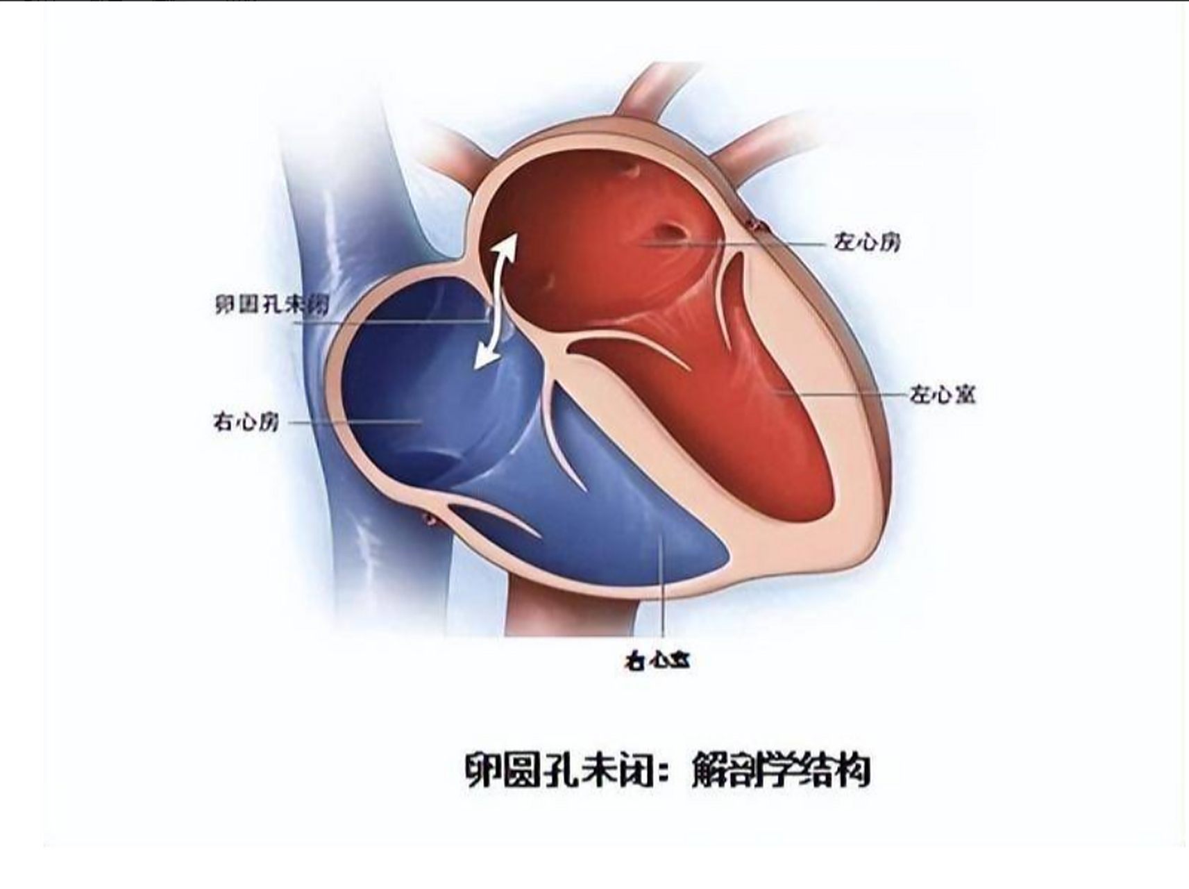 卵圆孔未闭具体什么情况下才需要干预?