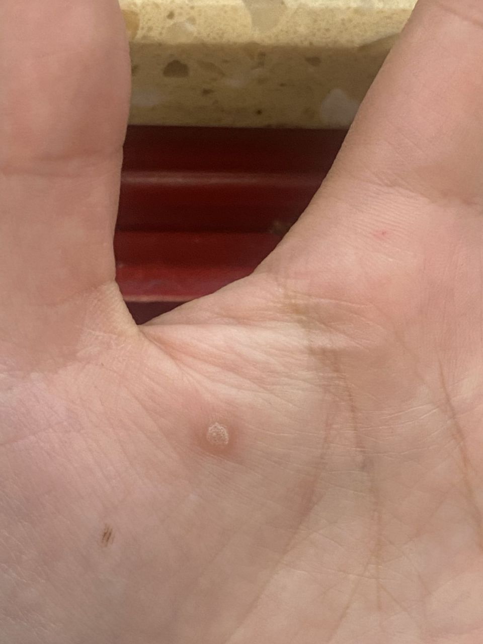 朋友们 帮我看看我对象手上这个咋回事  是不是鸡眼 感觉不像 有点像