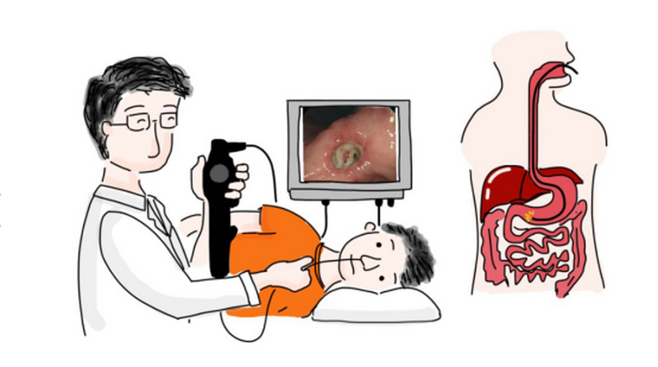 反流性食管炎是一种常见的消化系统疾病,近年来,随