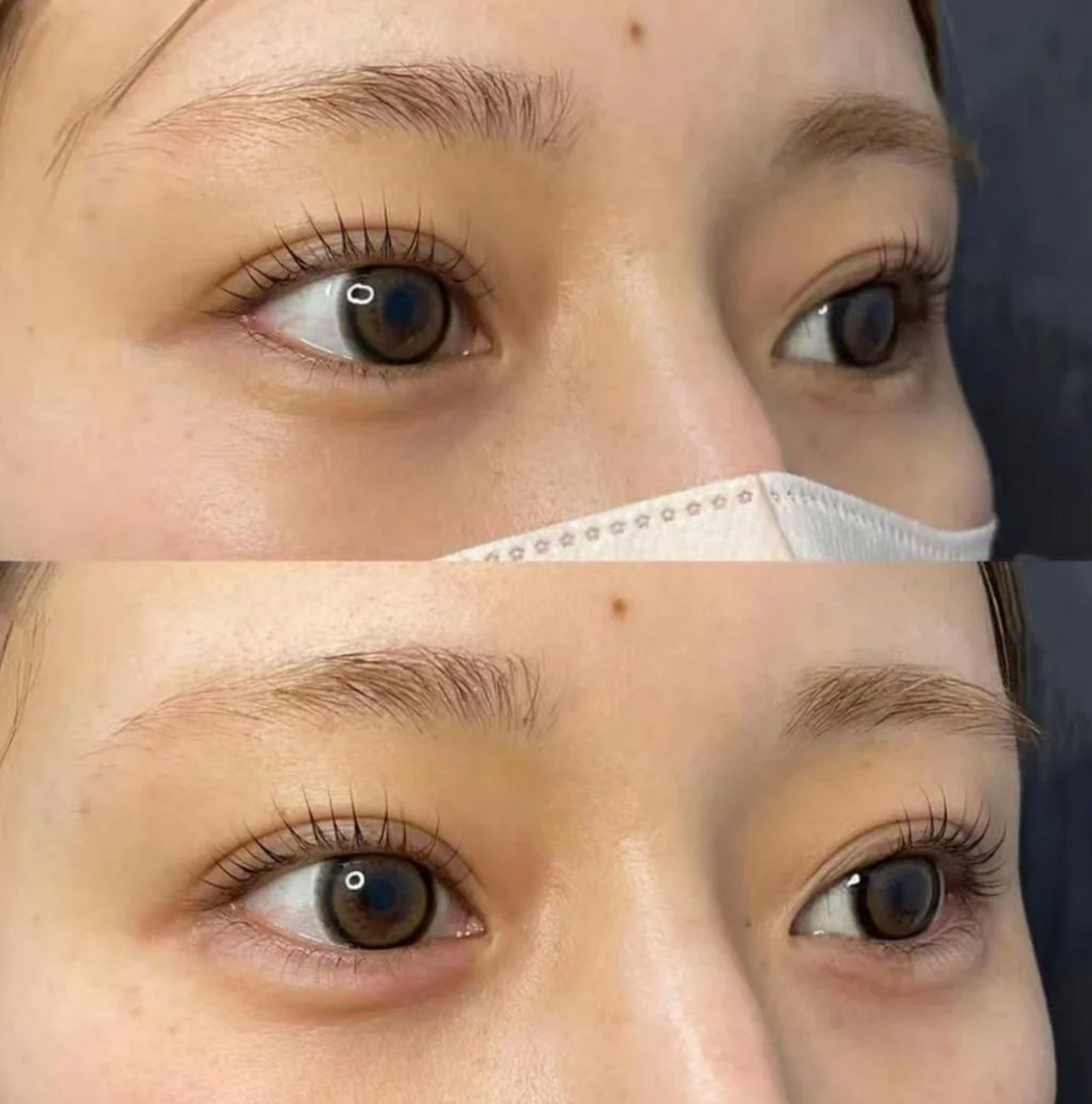 卧蚕填充用什么填 最好 #医美科普挑战赛#  卧蚕是指眼部下方出现的