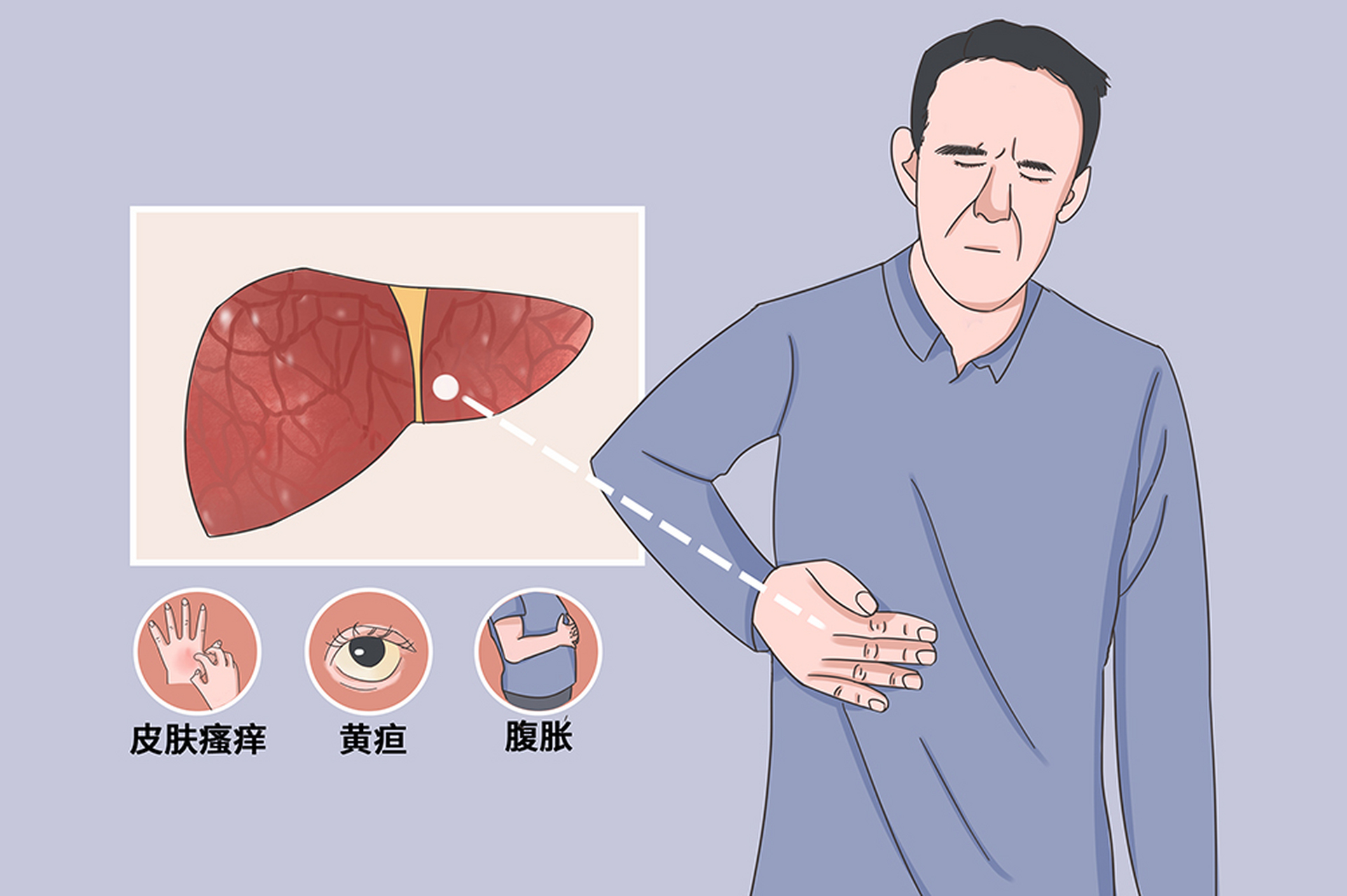 肝纤维化皮肤图片图片