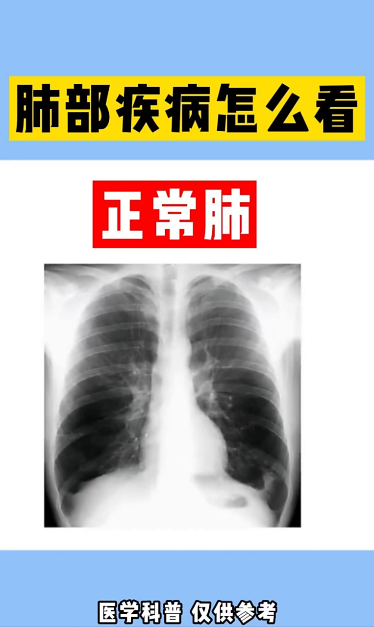 五张图,让你了解肺部疾病怎么看!#肺部疾病