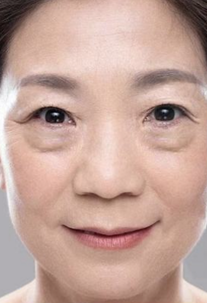 外切去眼袋# 黑眼袋很严重是身体哪里出问题了 眼袋黑眼圈的严重程度