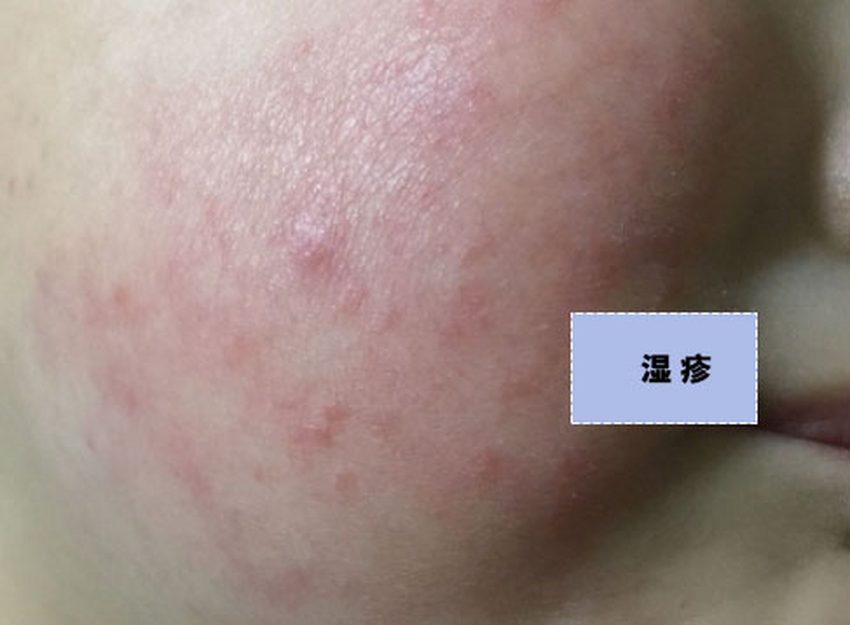 孩子身上长了一些红籽籽,是湿疹还是痱子,家长该如何区别?