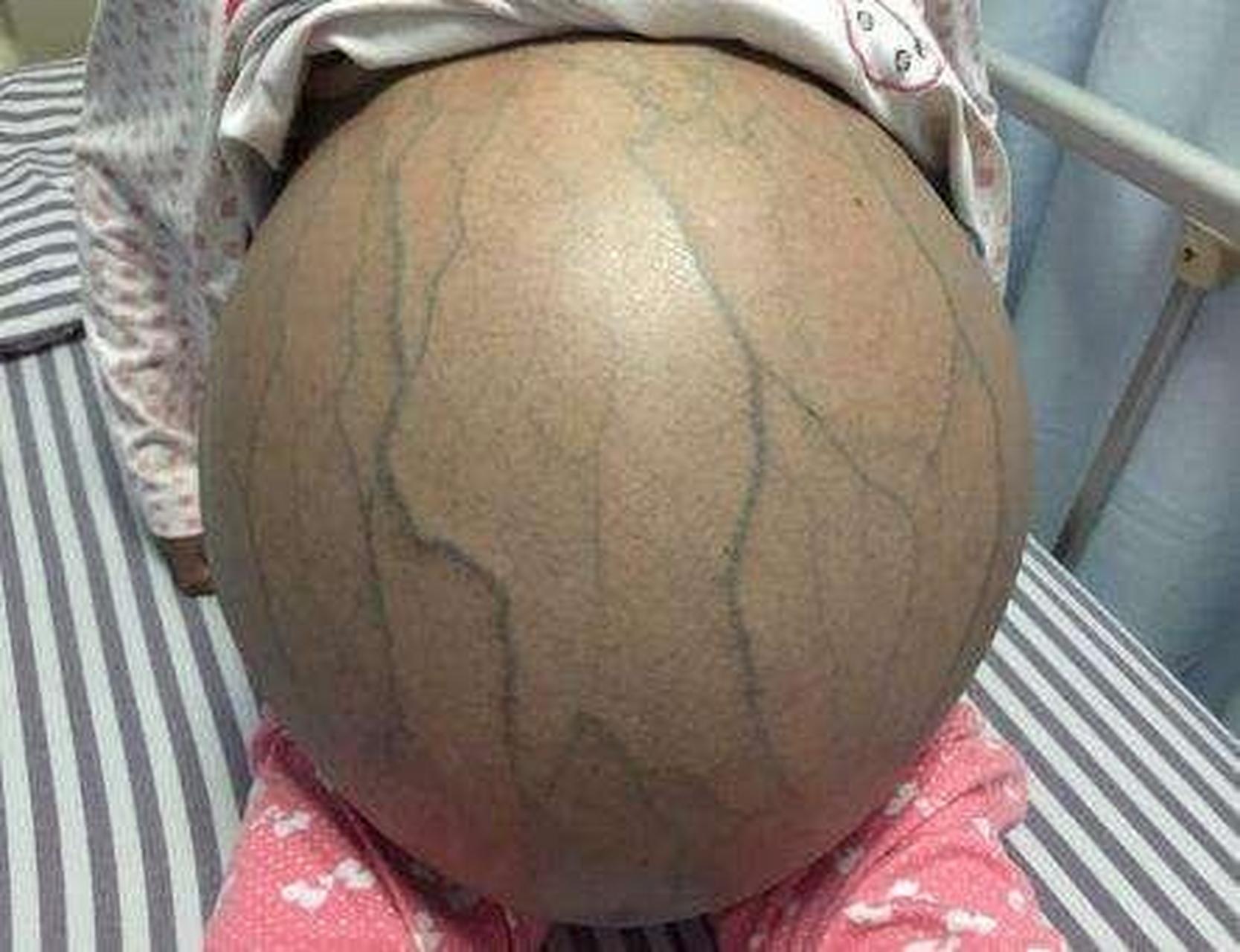 身体出现这6大症状,预示着肝腹水即将出现 肝硬化患者注意了,身体如果