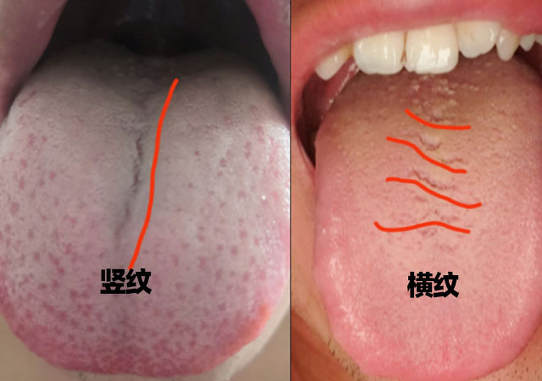 很多人舌头有裂纹,却不知道是咋回事 今天就给大家好好讲一讲.