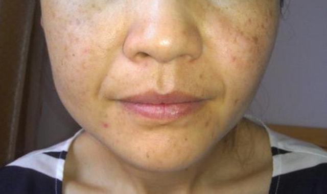 肝病面容5种表现,你属于哪一种.@陈燕力教授的动态