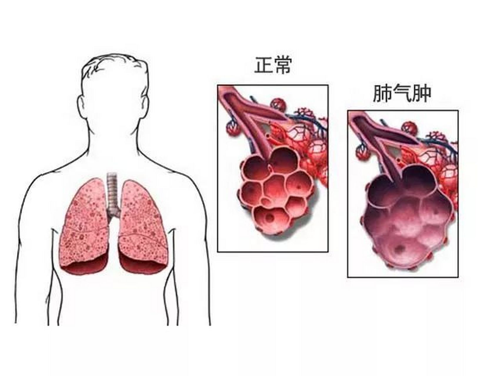 肺气肿的症状图片