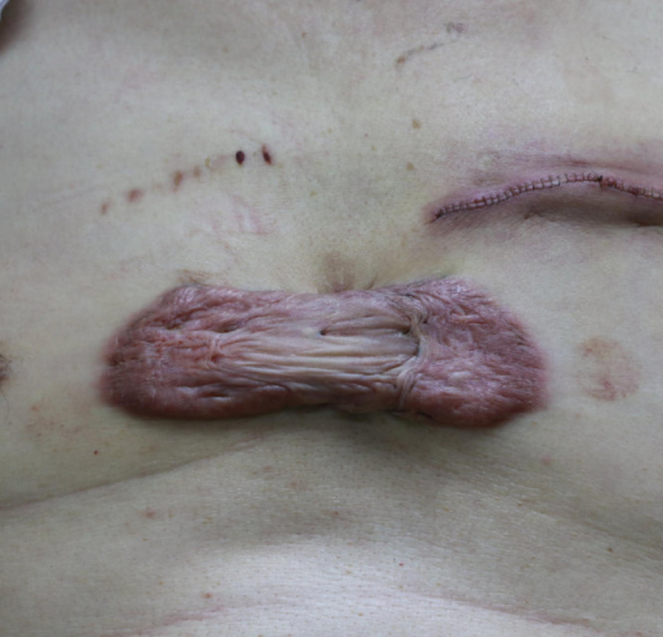 【前胸疤痕疙瘩手术切除治疗跟进】上周过来切除了其中一个疤痕疙瘩