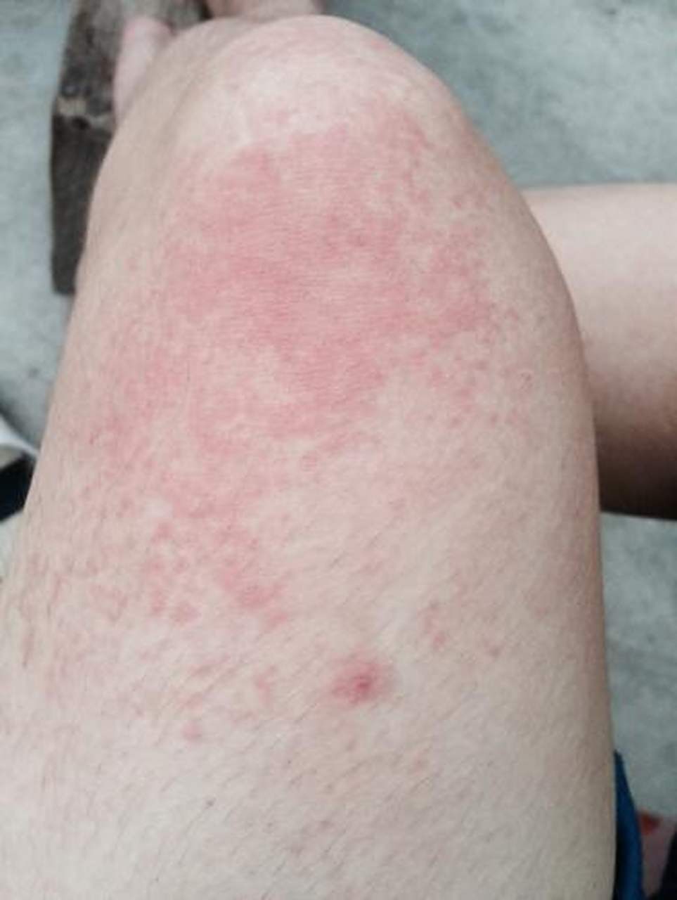 乙肝小伙浑身发痒!诊断竟然是肝硬化!