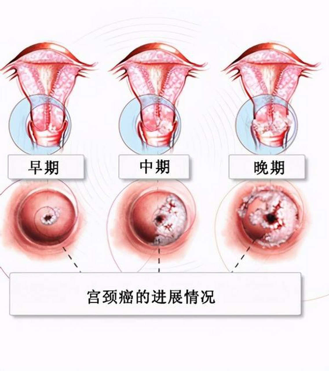 女人感染hpv52图片图片