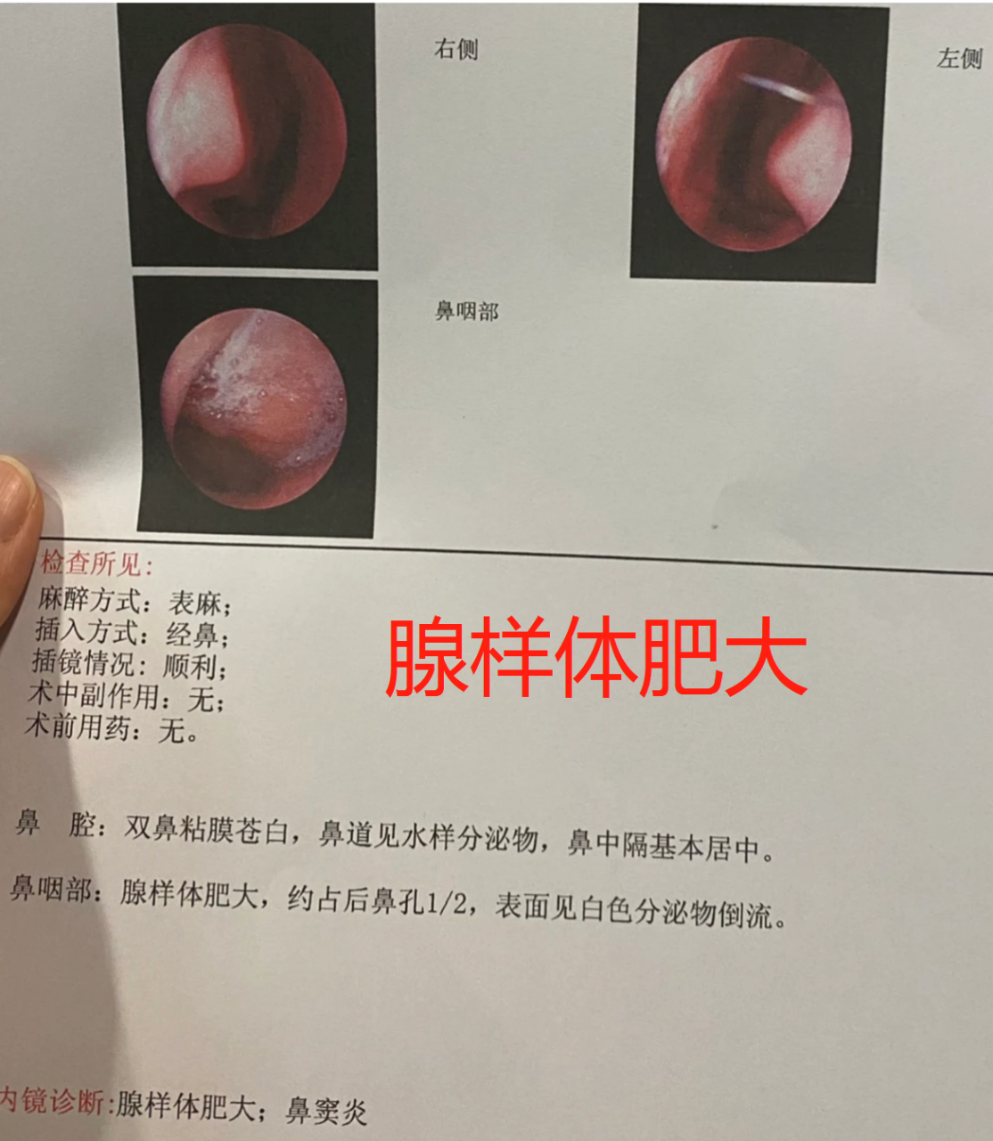儿童腺样体肥大,常见的3个中医调理方法  腺样体肥大临床表现为鼻塞