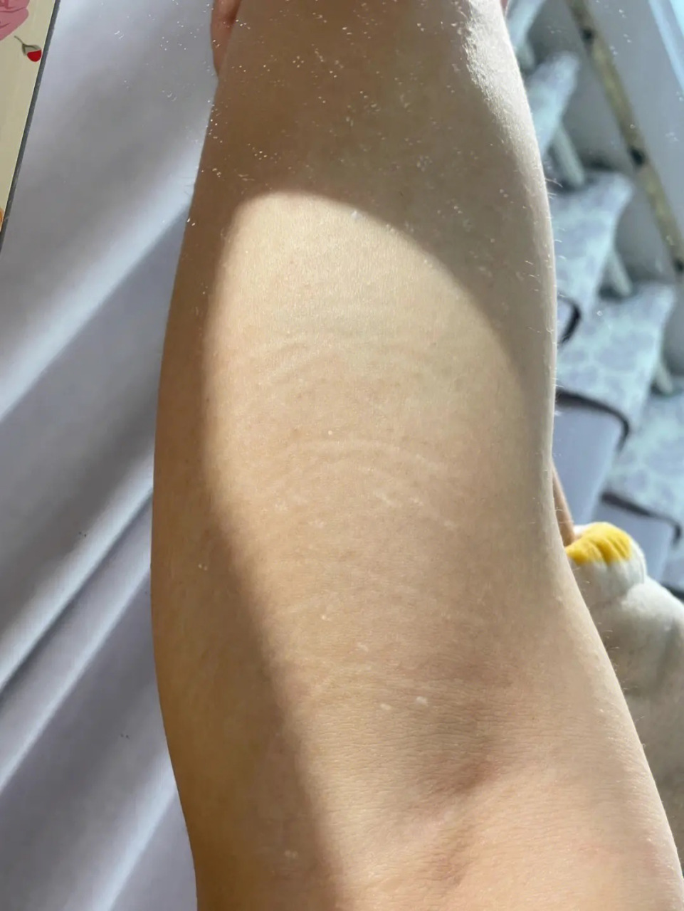 肥胖纹是什么样的图片  肥胖纹是由于体重快速增加或