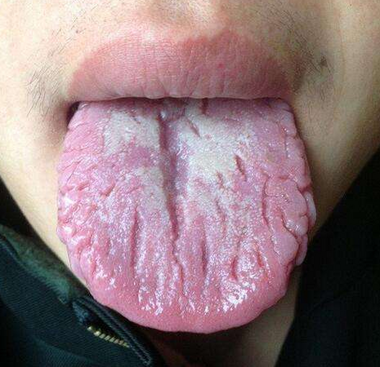 舌头有裂纹是怎么回事图片