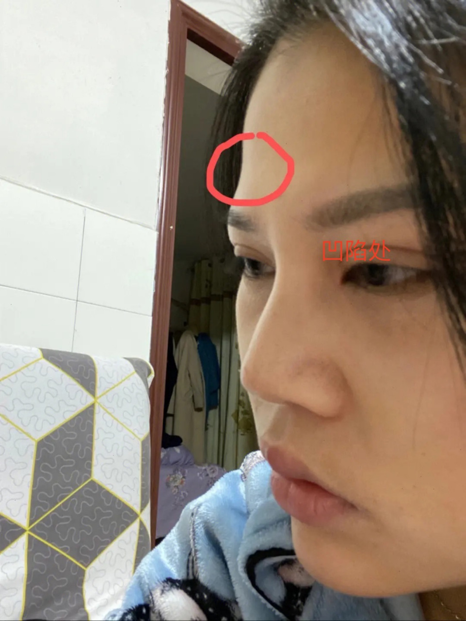 朋友打完玻尿酸,额头中间突然有一个凹陷?