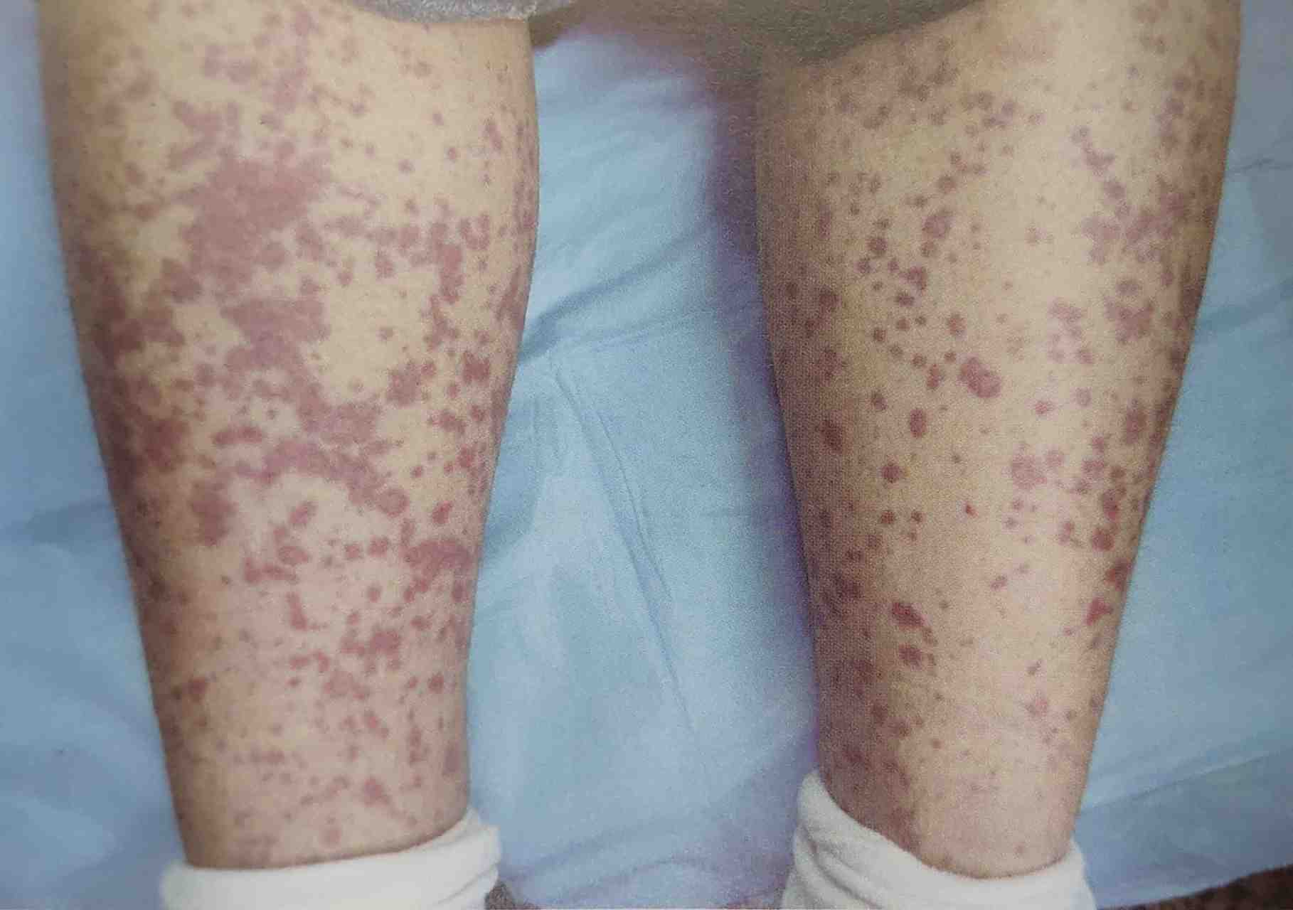 为什么成年过敏性紫癜患者也越来越多?  对于儿童过敏性紫癜患者主要